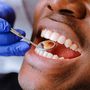 The image shows a person with a toothy smile being attended to by a dental professional who is cleaning or adjusting the person s teeth using dental instruments.