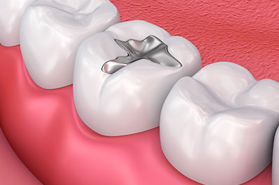 The image shows a close-up of a human mouth with a focus on a dental implant, which is a metallic post inserted into the jawbone to support a replacement tooth.