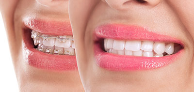 Close-up of a smiling woman with pink lipstick, showcasing teeth whitening results.