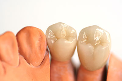 The image displays a set of artificial teeth placed on top of a row of dental implants, showcasing the appearance and fit of the teeth with the implants.