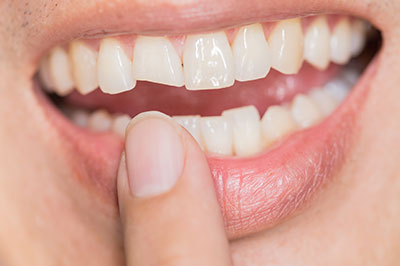 Person holding a toothbrush near their mouth, smiling with a missing front tooth.