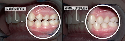 The image shows a pair of before-and-after photographs of a person s teeth, with the left side depicting a tooth with a cavity and the right showing the same tooth after treatment.