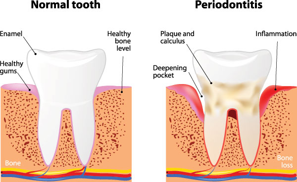 The image is a medical illustration showing the stages of tooth decay, from normal to periodontitis, with annotations explaining each stage.