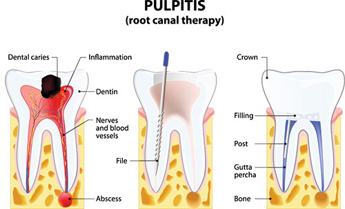 The image displays a diagrammatic illustration of the process of pulpitis, showing stages from initial infection to the formation of an abscess. It includes labeled parts such as dental caries, inflammation, and the tooth s pulp chamber with a visible cavity and nerve endings.