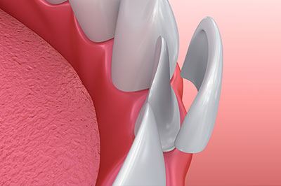 An illustration of a mouth with a focus on dental implants, showcasing the implant s design and integration into the gum tissue.