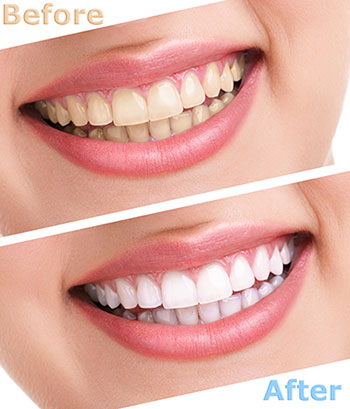 The image shows a before and after comparison of dental care, featuring a person s smile with yellow teeth on the left side and a bright white smile on the right.