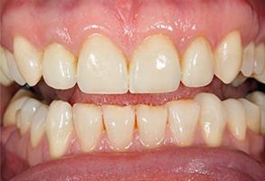 The image shows a close-up of a person s teeth with some discoloration, likely from coffee or tobacco use.