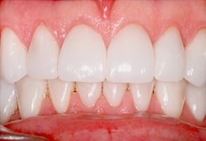 Dental implant with a natural-looking crown.