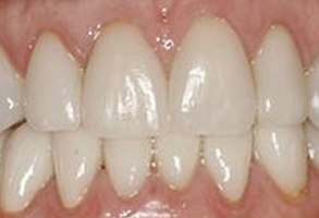The image shows a close-up of a person s teeth with a focus on the lower front teeth, which appear to be yellowed or stained.