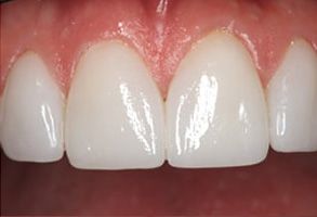 White teeth with a red gumline, showcasing a dental implant or bridge.