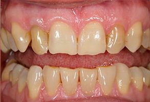 The image shows a close-up of an individual s teeth with yellowing, indicating possible dental issues such as staining or decay.