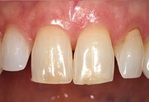 Dental implant with a natural-looking crown.